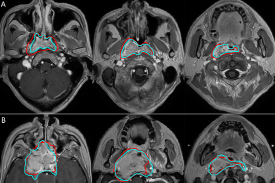 AI used to pinpoint head and neck cancer treatment