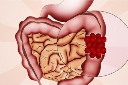 Colon cancer screening key to survival